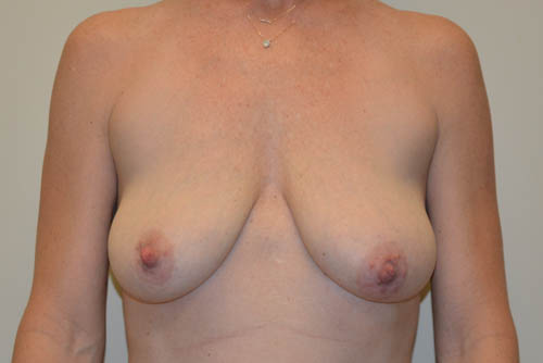 Breast-Lift-07 | Before Breast Lift