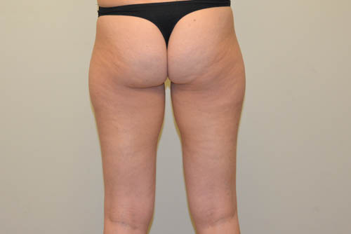 Liposuction-06 | Before Liposuction 2