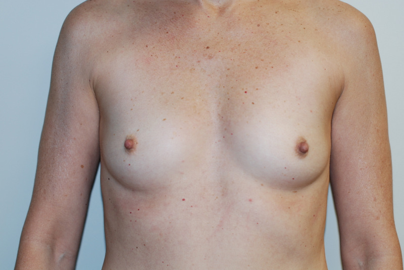 Breast-Augmentation-07 | Before Breast Augmentation