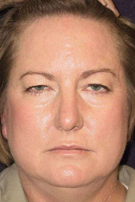 Eyelid-Surgery-08 | Before Eyelid Surgery 1