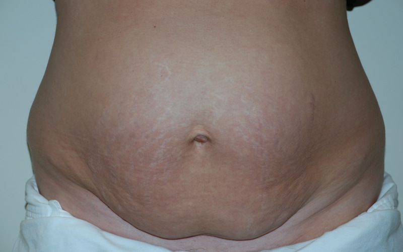 Tummy-Tuck-10 | Before Tummy Tuck