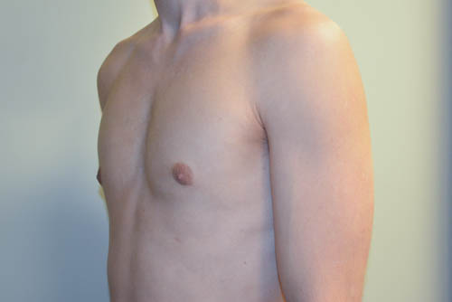 Male-Breast-Reduction-07 | After Male Breast Reduction 4