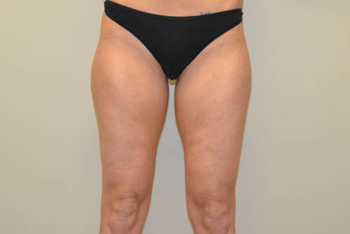 Liposuction-06 | Before Liposuction