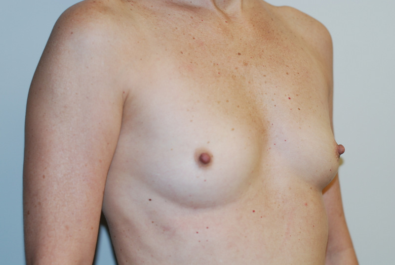 Breast-Augmentation-07 | Before Breast Augmentation 2