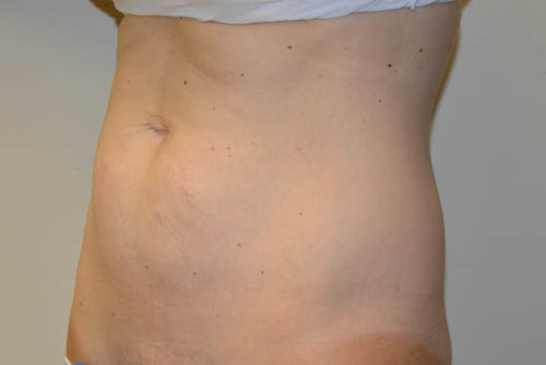Mini-Tummy-Tuck-07 | Before Mini Tummy Tuck 2