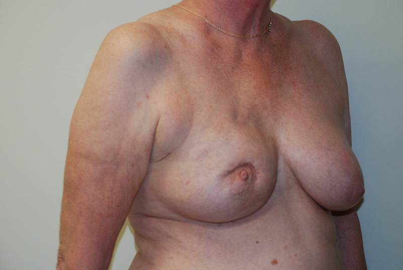 Breast-Reconstruction-Tissue-Expander-07 | Before Breast Reconstruction Tissue Expanders 2