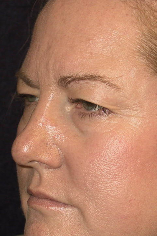 Eyelid-Surgery-08 | Before Eyelid Surgery 2
