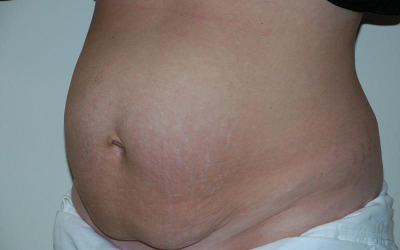 Tummy-Tuck-10 | Before Tummy Tuck 2