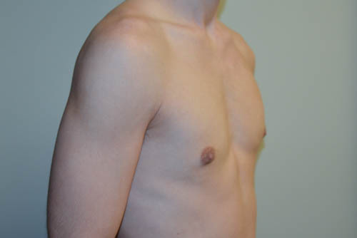 Male-Breast-Reduction-07 | After Male Breast Reduction 2