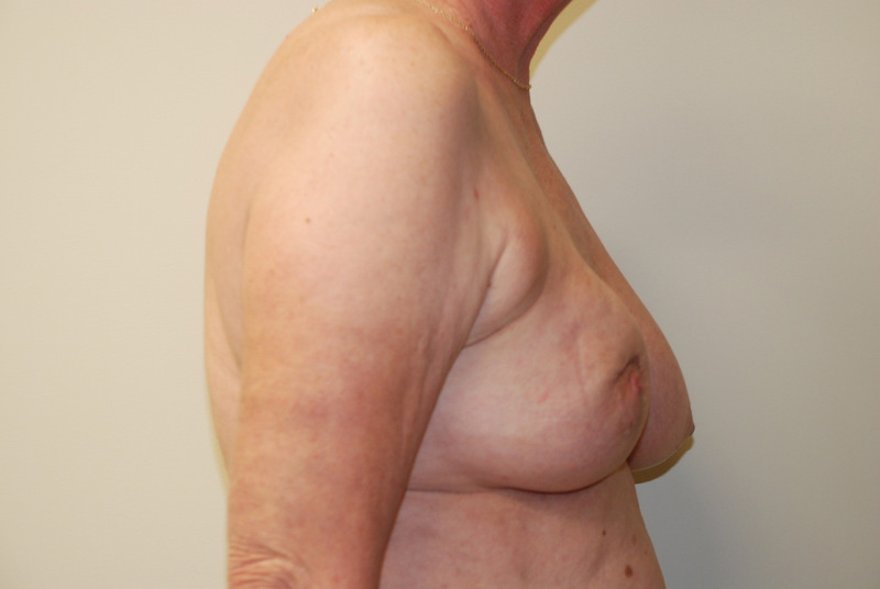 Breast-Reconstruction-Tissue-Expander-07 | Before Breast Reconstruction Tissue Expanders 3