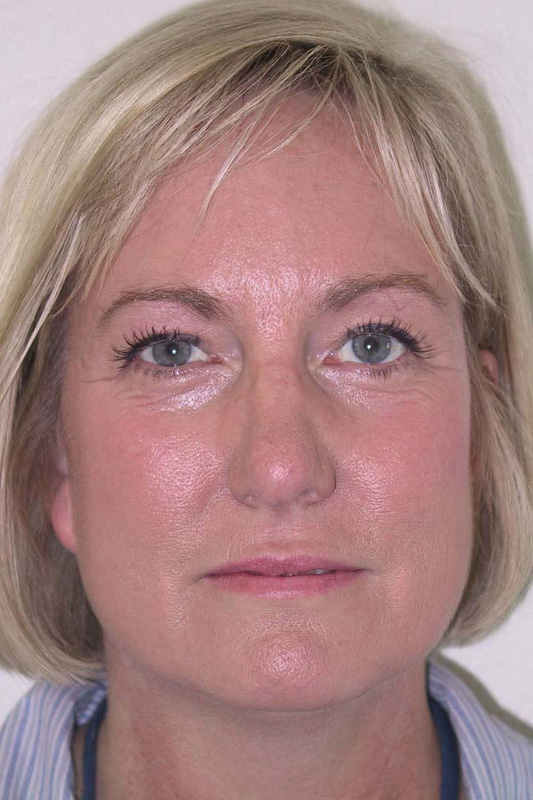 Eyelid-Surgery-08 | After Eyelid Surgery 1