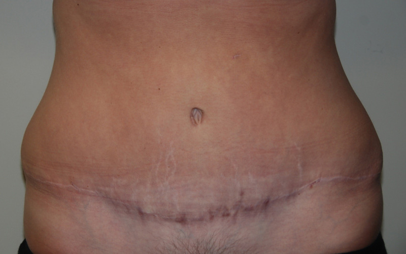 Tummy-Tuck-10 | After Tummy Tuck