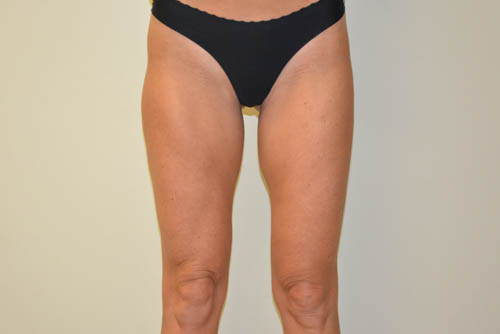 Liposuction-06 | After Liposuction