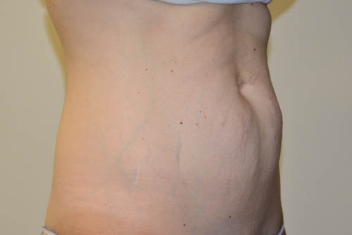 Mini-Tummy-Tuck-07 | Before Mini Tummy Tuck 4