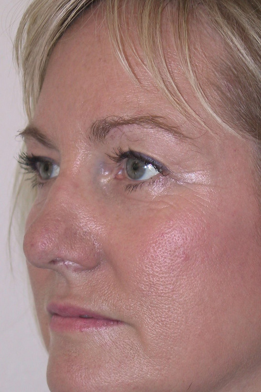 Eyelid-Surgery-08 | After Eyelid Surgery 2