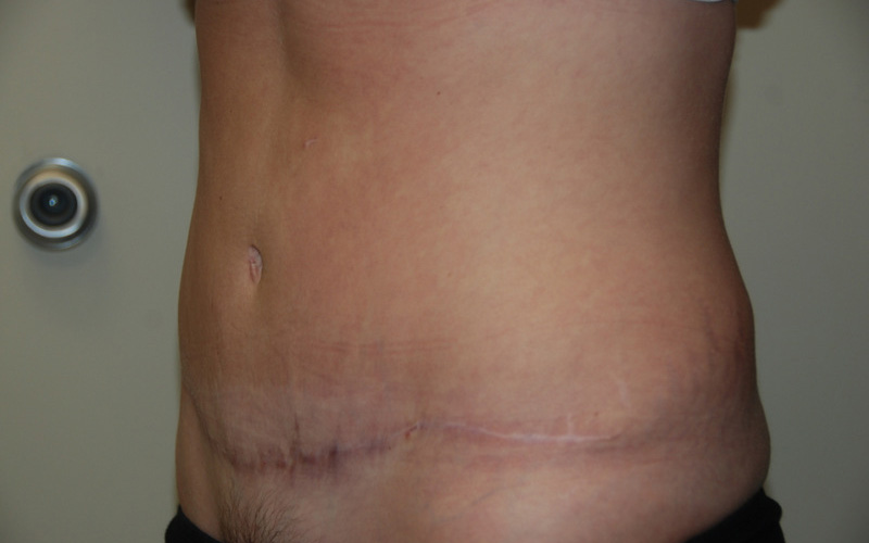 Tummy-Tuck-10 | After Tummy Tuck 2