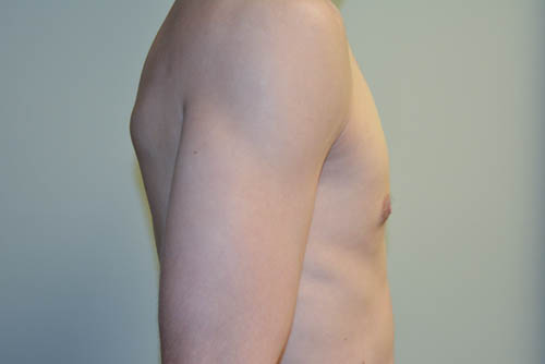 Male-Breast-Reduction-07 | After Male Breast Reduction 3