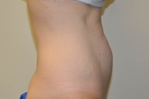 Mini-Tummy-Tuck-07 | Before Mini Tummy Tuck 5
