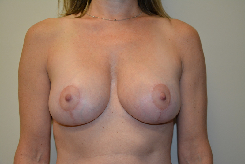 Breast-Lift-and-Augmentation-08 | After Breast Lift and Augmentation