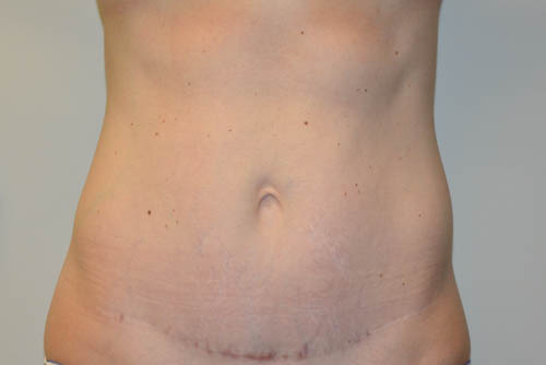 Mini-Tummy-Tuck-07 | After Mini Tummy Tuck