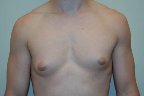 Male-Breast-Reduction-07 | Before Male Breast Reduction