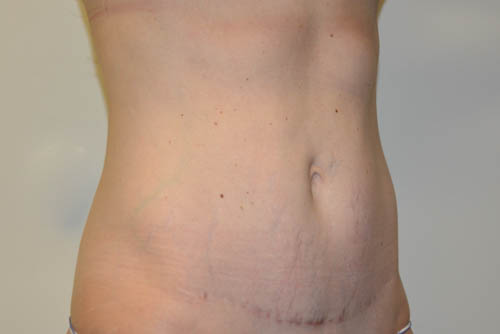 Mini-Tummy-Tuck-07 | After Mini Tummy Tuck 4