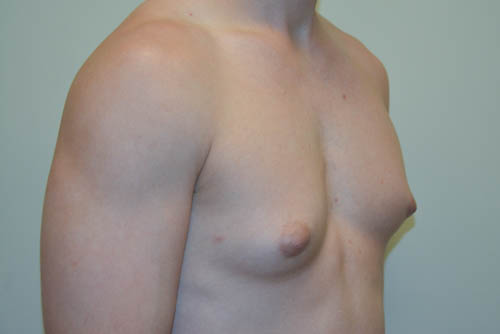 Male-Breast-Reduction-07 | Before Male Breast Reduction 2