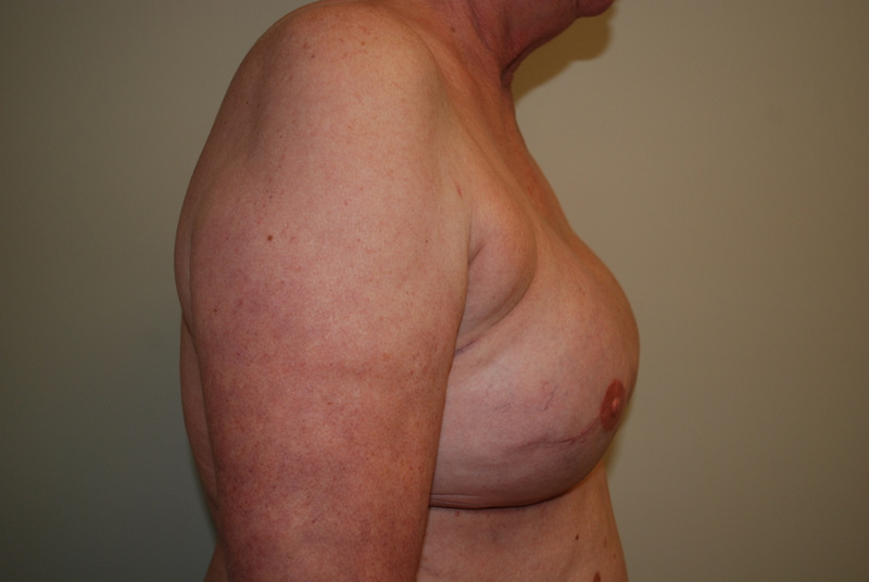 Breast-Reconstruction-Tissue-Expander-07 | After Breast Reconstruction Tissue Expanders 3