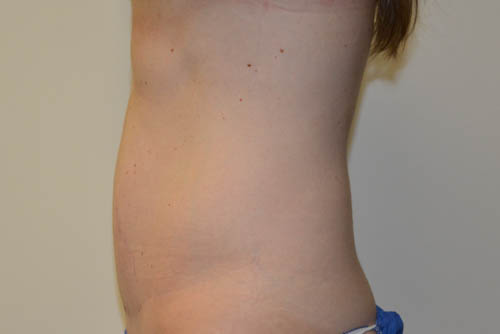 Mini-Tummy-Tuck-07 | After Mini Tummy Tuck 3
