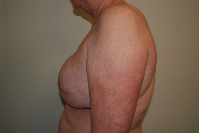 Breast-Reconstruction-Tissue-Expander-07 | After Breast Reconstruction Tissue Expanders 5