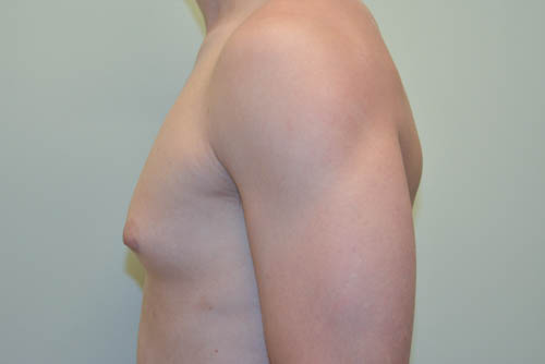 Male-Breast-Reduction-07 | Before Male Breast Reduction 5