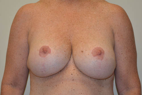 Implant-Removal-07 | Before Implant Removal