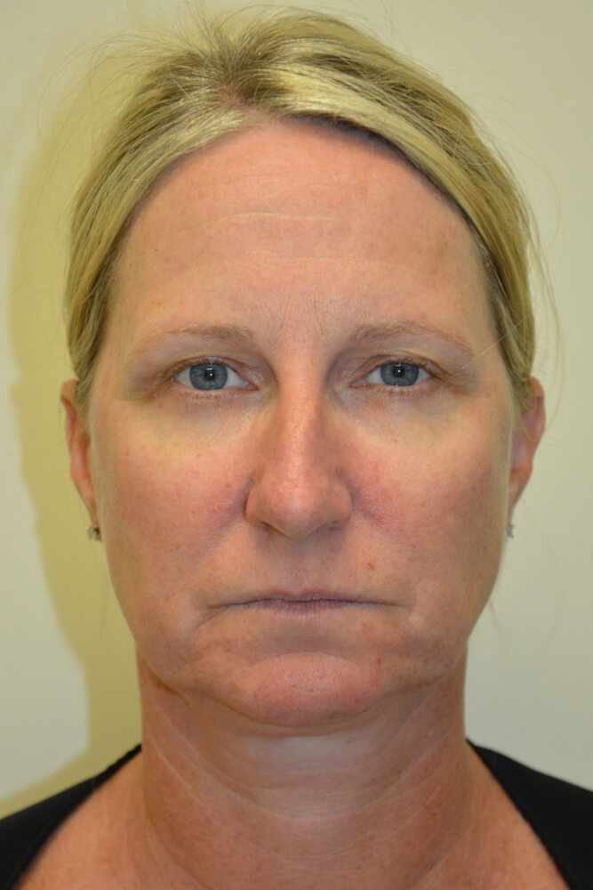 Rhinoplasty-08 | Before Rhinoplasty