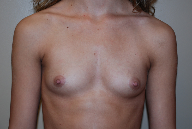 Breast-Augmentation-08 | Before Breast Augmentation