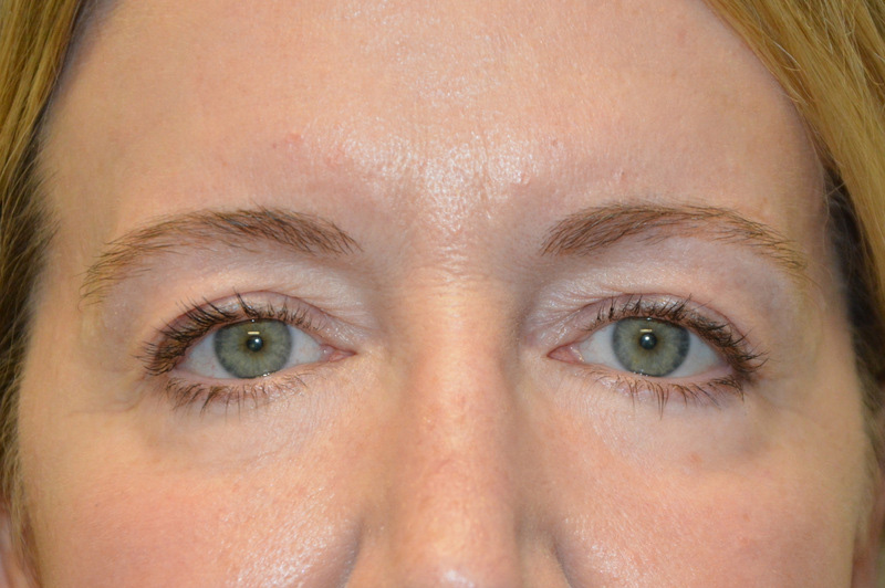 Eyelid-Surgery-09 | Before Eyelid Surgery 1