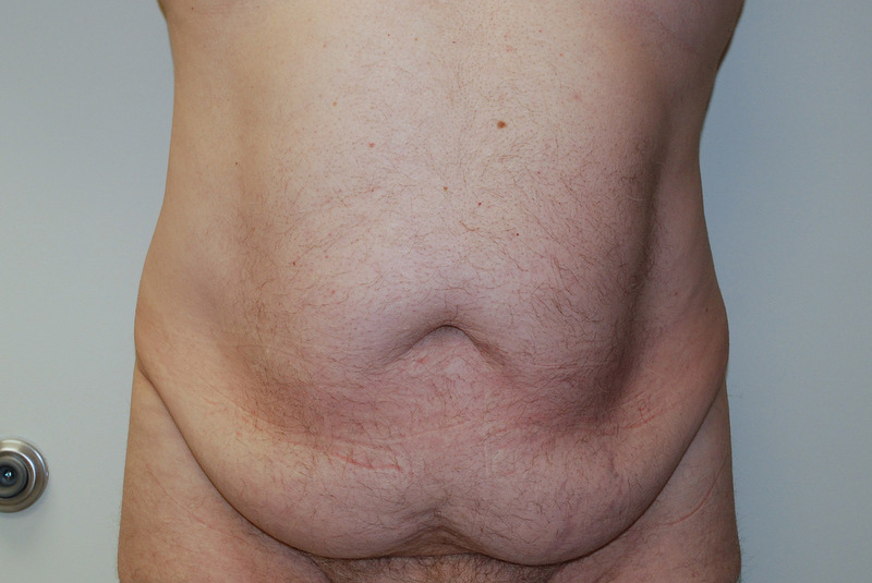 Tummy-Tuck-11 | Before Tummy Tuck