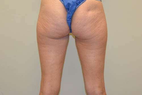 Liposuction-03 | Before Liposuction 2