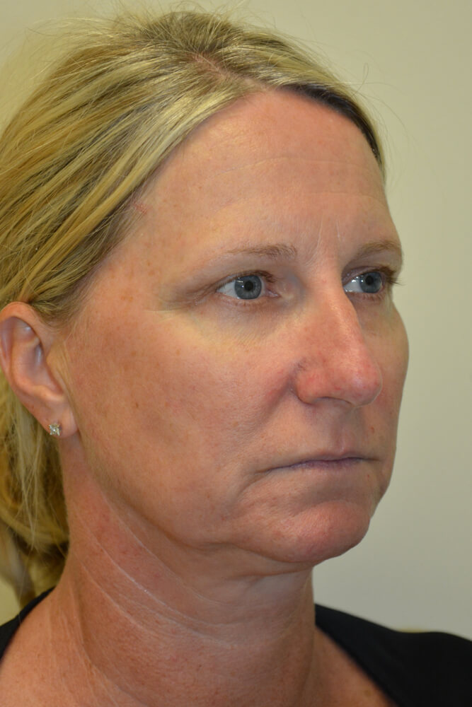 Rhinoplasty-08 | Before Rhinoplasty 2