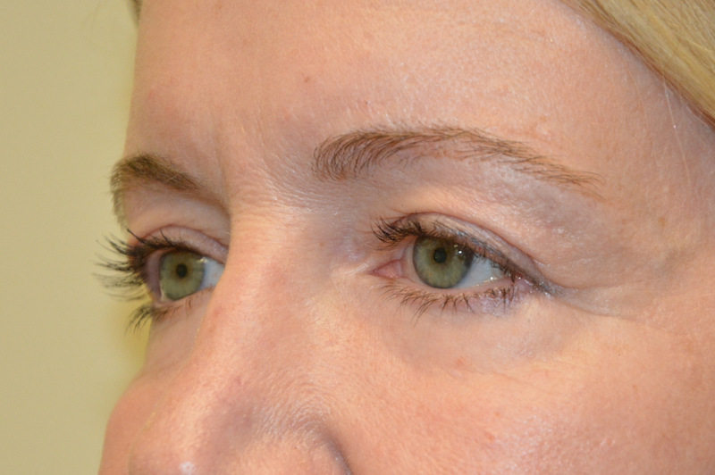 Eyelid-Surgery-09 | Before Eyelid Surgery 2