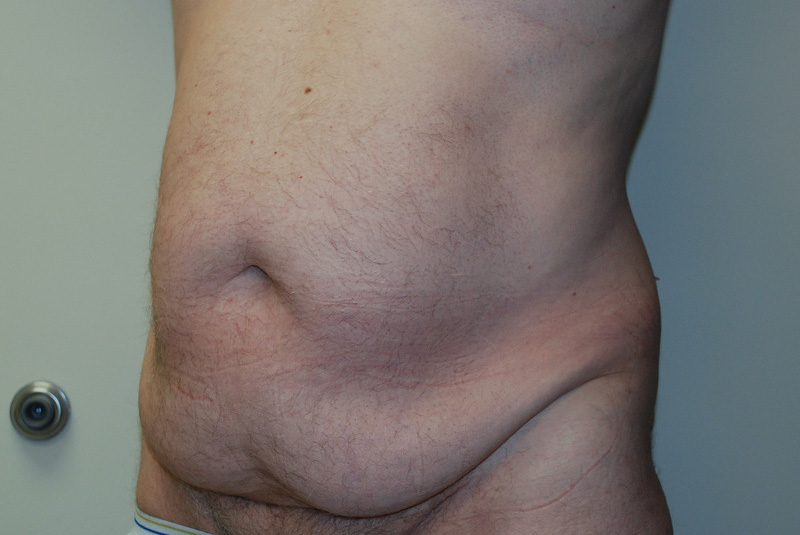 Tummy-Tuck-11 | Before Tummy Tuck 2