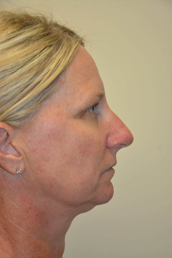 Rhinoplasty-08 | Before Rhinoplasty 3