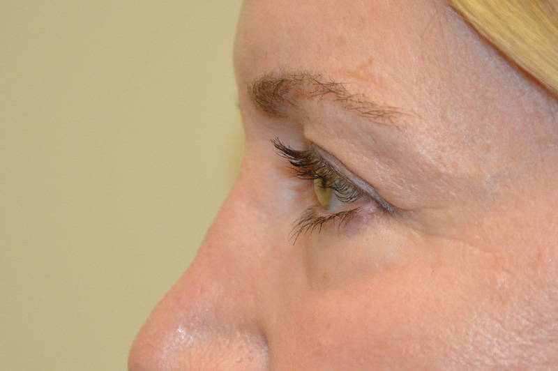 Eyelid-Surgery-09 | Before Eyelid Surgery 3