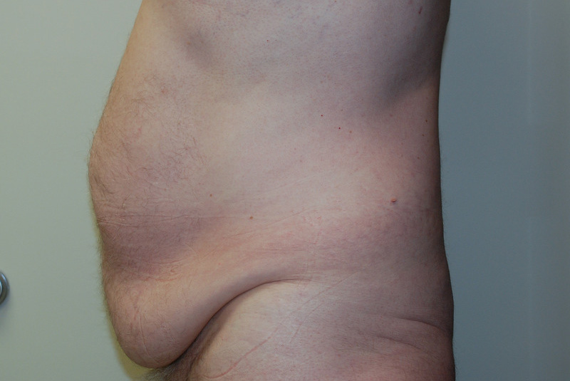 Tummy-Tuck-11 | Before Tummy Tuck 3
