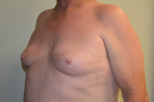 Male-Breast-Reduction-08 | Before Male Breast Reduction 4
