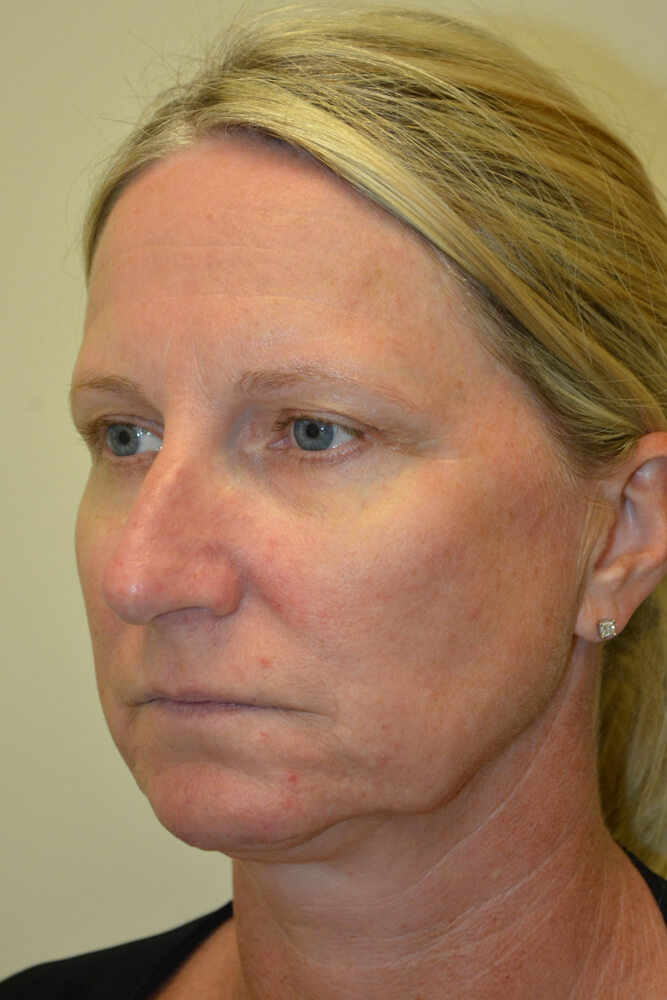Rhinoplasty-08 | Before Rhinoplasty 4