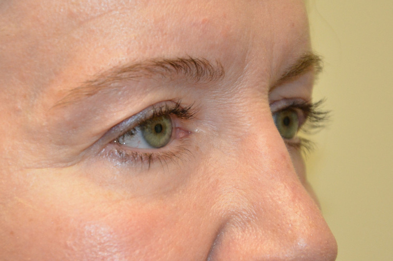 Eyelid-Surgery-09 | Before Eyelid Surgery 4