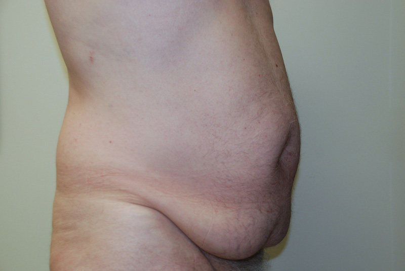 Tummy-Tuck-11 | Before Tummy Tuck 4
