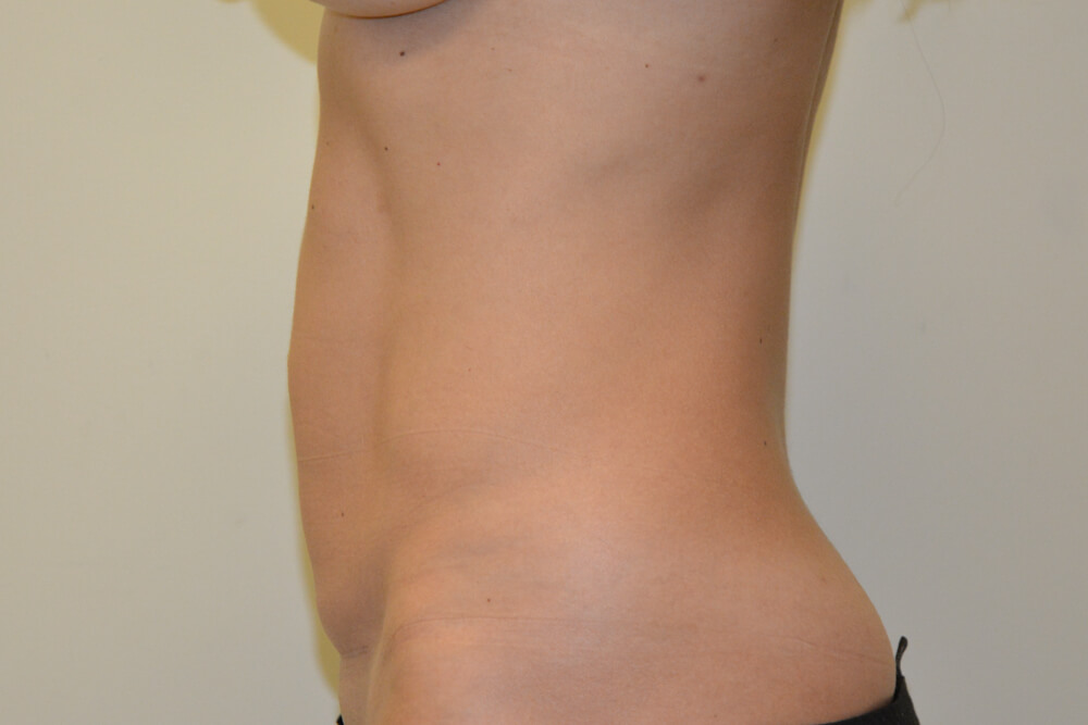Mini-Tummy-Tuck-08 | Before Mini Tummy Tuck 5