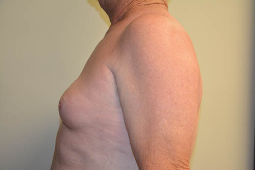 Male-Breast-Reduction-08 | Before Male Breast Reduction 5