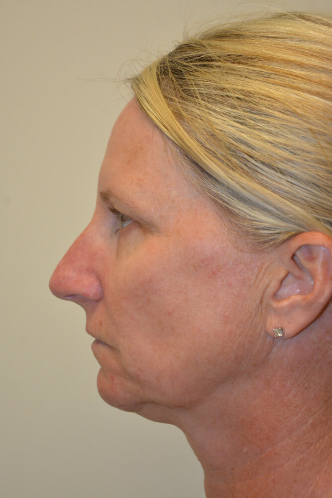 Rhinoplasty-08 | Before Rhinoplasty 5